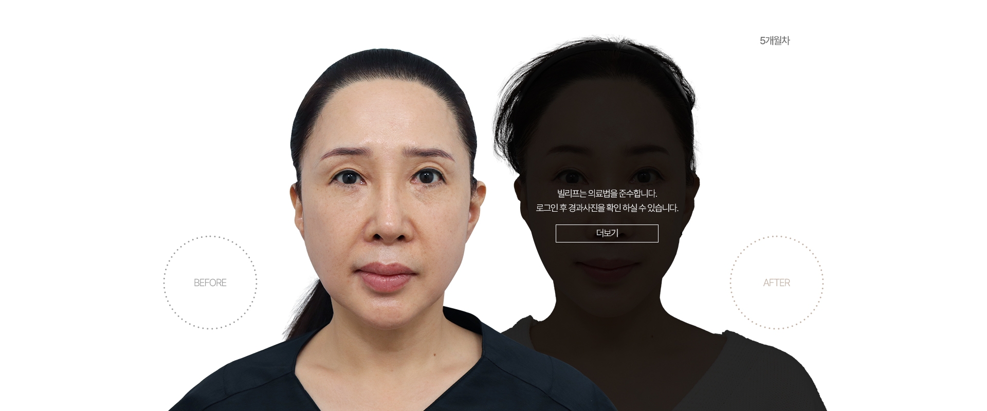 5개월차 BEFORE - AFTER