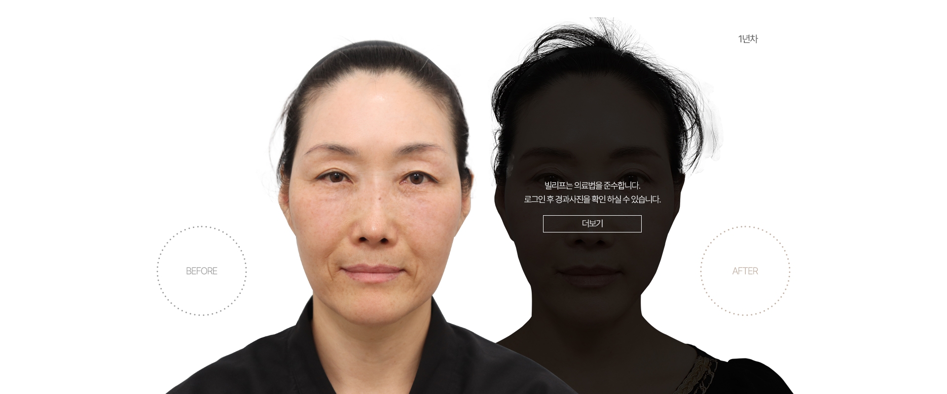 5개월차 BEFORE - AFTER