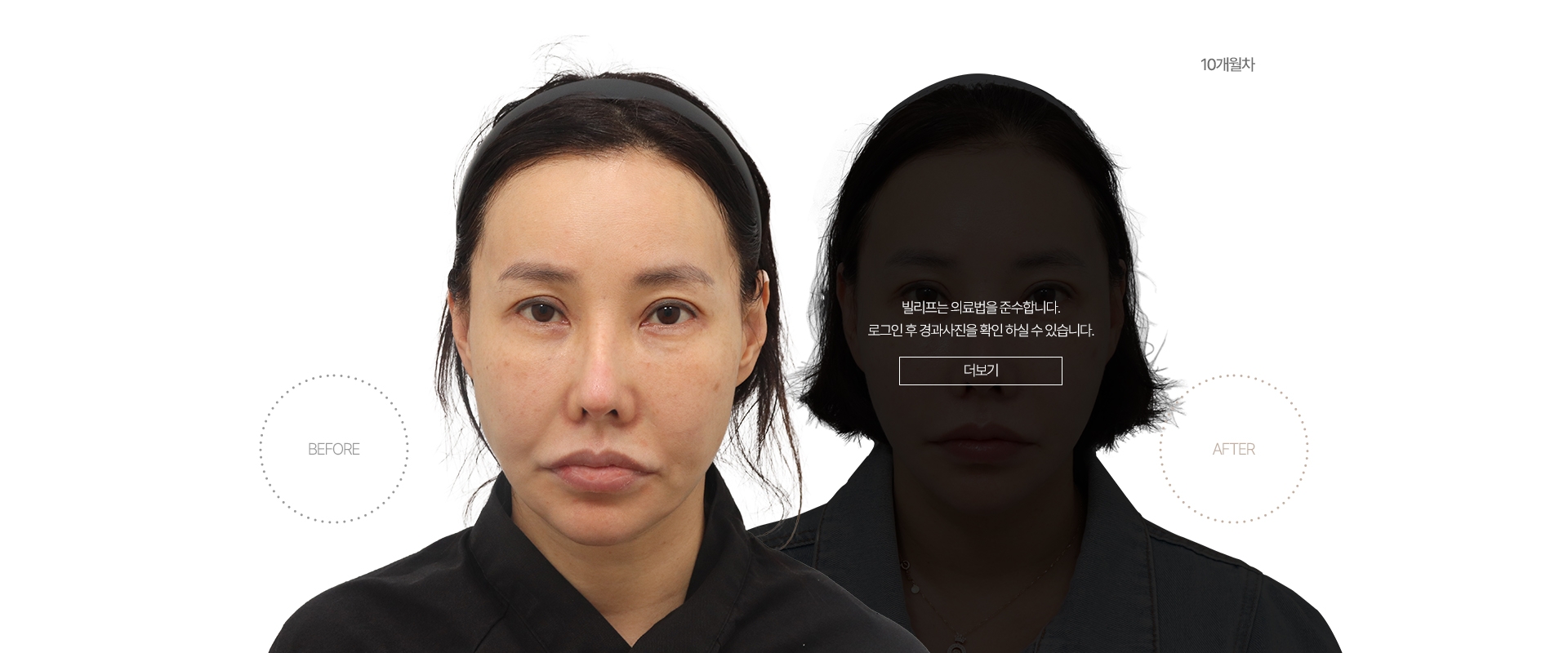 5개월차 BEFORE - AFTER