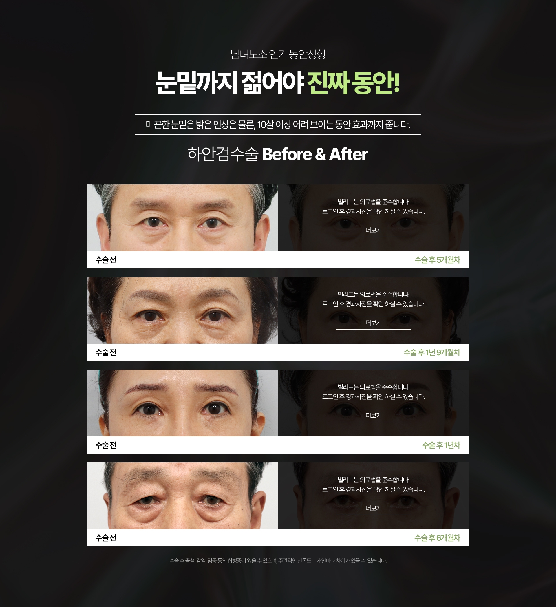남녀노소 인기 동안성형 눈밑까지 젊어야 진짜 동안! 매끈한 눈밑은 밝은 인상은 물론, 10살 이상 어려 보이는 동안 효과까지 줍니다. *수술 후 출혈,감염,염증 등의 합병증이 있을 수 있으며 주관적인 만족도는 개인마다 차이가 있을 수 있습니다.
