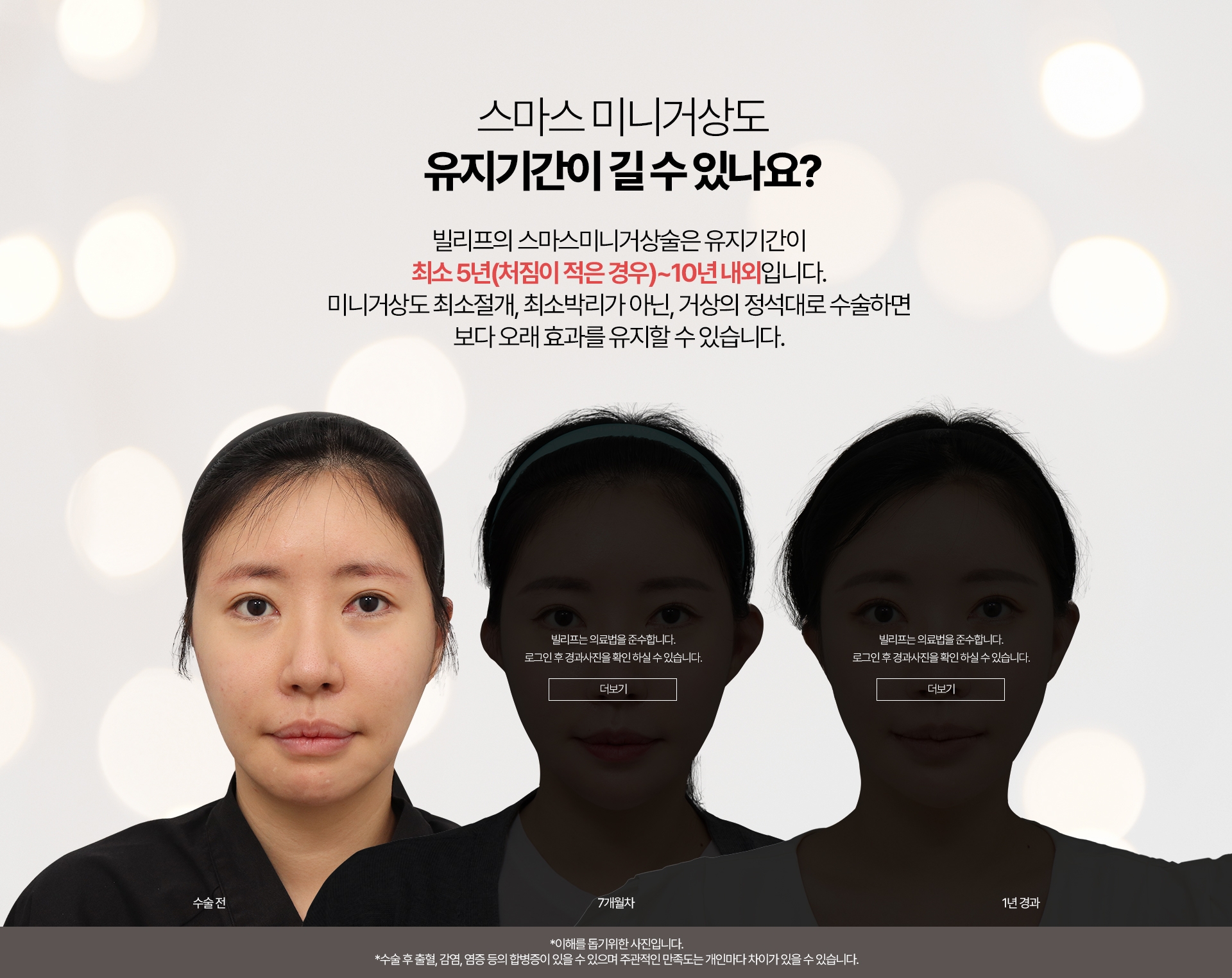 스마스 미니거상도   유지기간이 길 수 있나요? 빌리프의 스마스미니거상술은 유지기간이 최소 5년(처짐이 적은 경우)~10년 내외입니다 1년에서 1년6개월까지 흉살이 빠진 뒤부터는 만족스러운 결과가 오래 유지되는 것을 느끼실 수 있습니다.