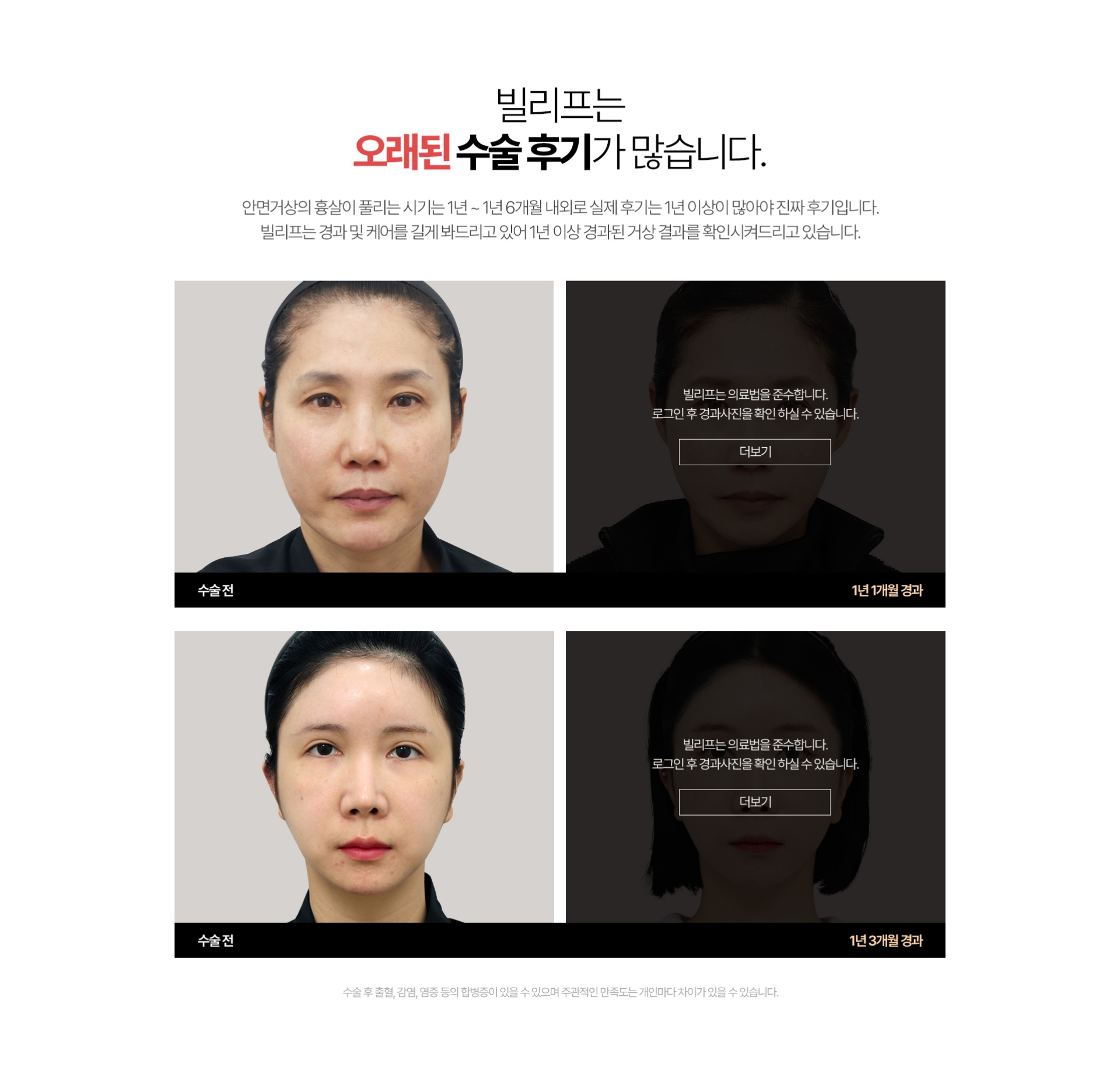 빌리프는 오래된 수술 후기가 많습니다. 스마스미니거상의 흉살이 풀리는 시기는 1년~ 1년 6개월 내외로실제 후기는 1년 이상이 많아야 진짜 후기입니다 빌리프는 경과 및 케어를 길게 봐드리고 있어 1년 이상 경과된 거상 결과를 확인시켜드리고 있습니다.