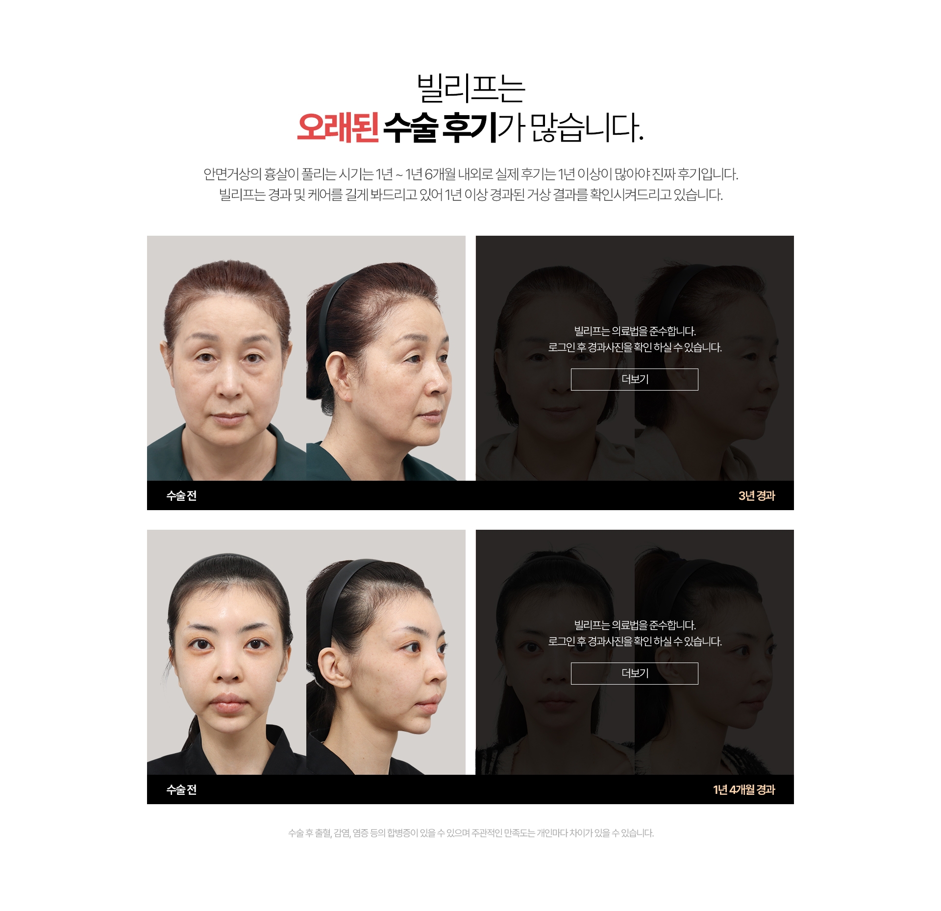 빌리프는 오래된 수술 후기가 많습니다. 안면거상의 흉살이 풀리는 시기는 1년~ 1년 6개월 내외로실제 후기는 1년 이상이 많아야 진짜 후기입니다 빌리프는 경과 및 케어를 길게 봐드리고 있어 1년 이상 경과된 거상 결과를 확인시켜드리고 있습니다. 수술 후 출혈, 감염, 염증 등의 합병증이 있을 수 있으며 주관적인 만족도는 개인마다 차이가 있을 수 있습니다.