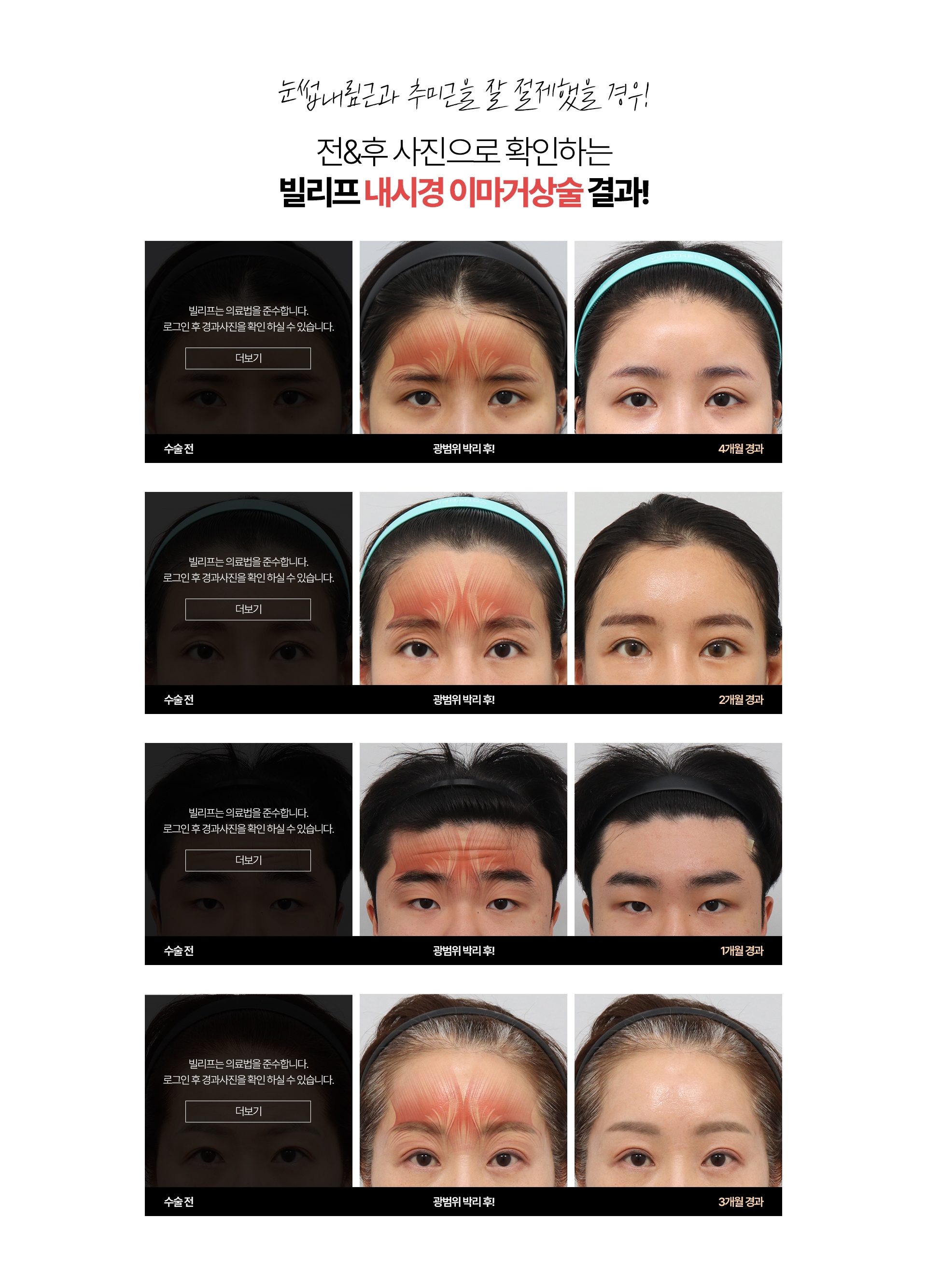 눈썹내림근과 추미근을 잘 절제했을 경우! 전&후사진으로 확인하는 빌리프 내시경 이마거상술 결과!