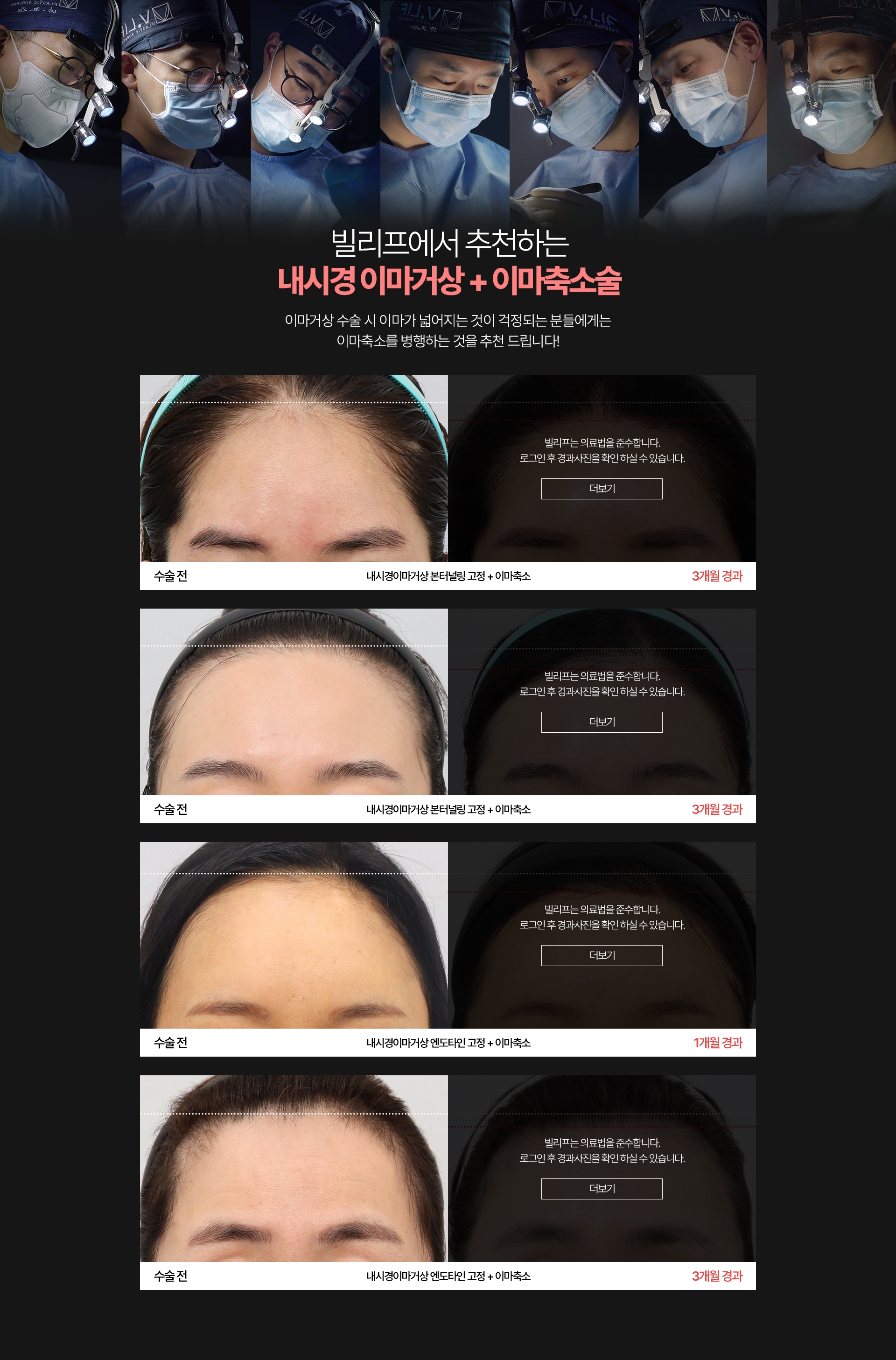 빌리프에서 추천하는 내시경 이마거상 + 이마축소술 이마거상 수술 시 이마가 넓어지는 것이 걱정되는 분들에게는 이마축소를 병행하는 것을 추천 드립니다! 수술전 3개월경과 - 내시경이마거상 본터널링 고정 + 이마축소, 수술전 3개월 경과 - 내시경이마거상 본터널링 고정 + 이마축소