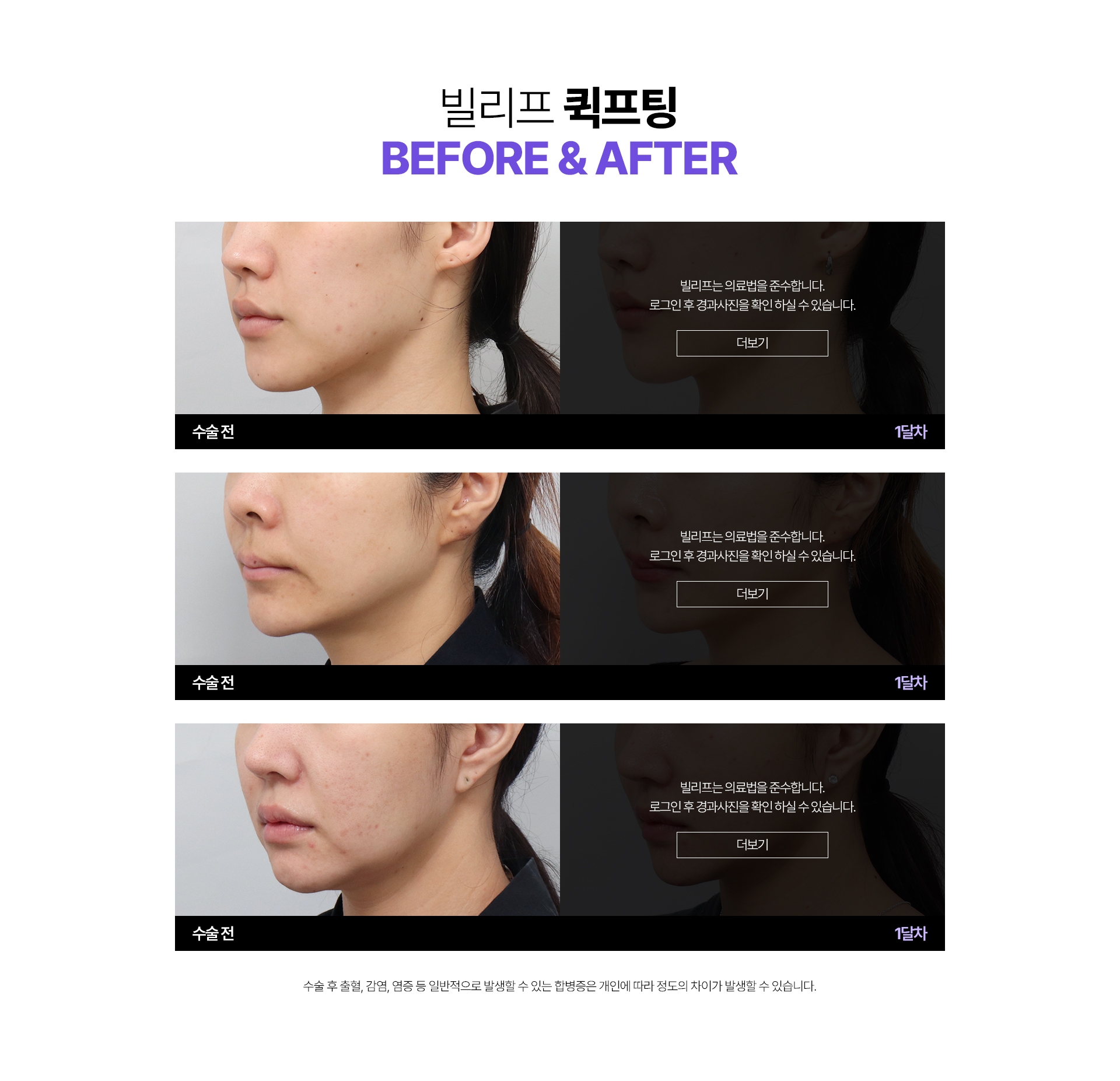 빌리프 퀵프팅 Before & After 수술전 - 1달차