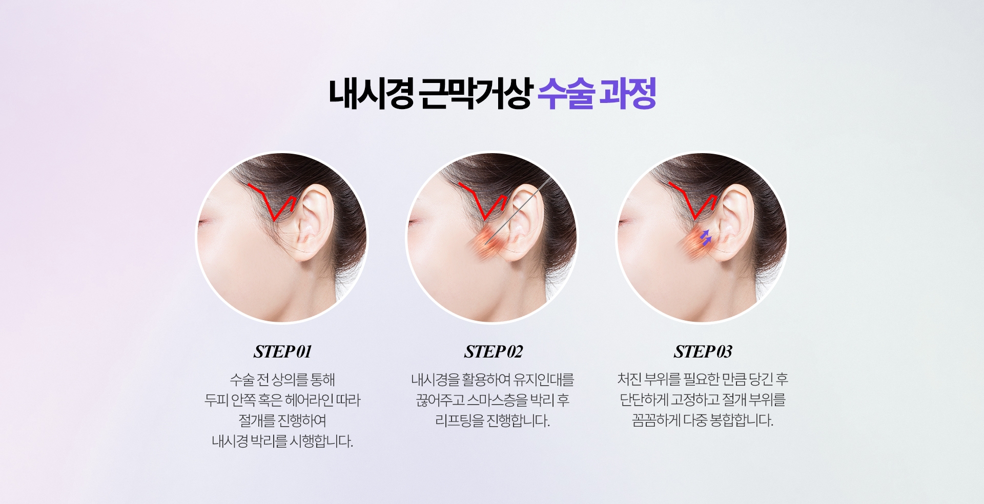 내시경 근막거상 수술 과정 STEP 1. 헤어라인 위쪽 ~ 귀앞과 귓볼 부위에 절개를 통해 내시경 박리를 시행합니다. STEP 2. 내시경을 활용하여 유지인대를 끊어주고 스마스층을 박리 후 리프팅을 진행합니다. STEP 3. 처진 부위를 필요한 만큼 당긴 후 단단하게 고정하고 절개 부위를  꼼꼼하게 다중 봉합합니다.
