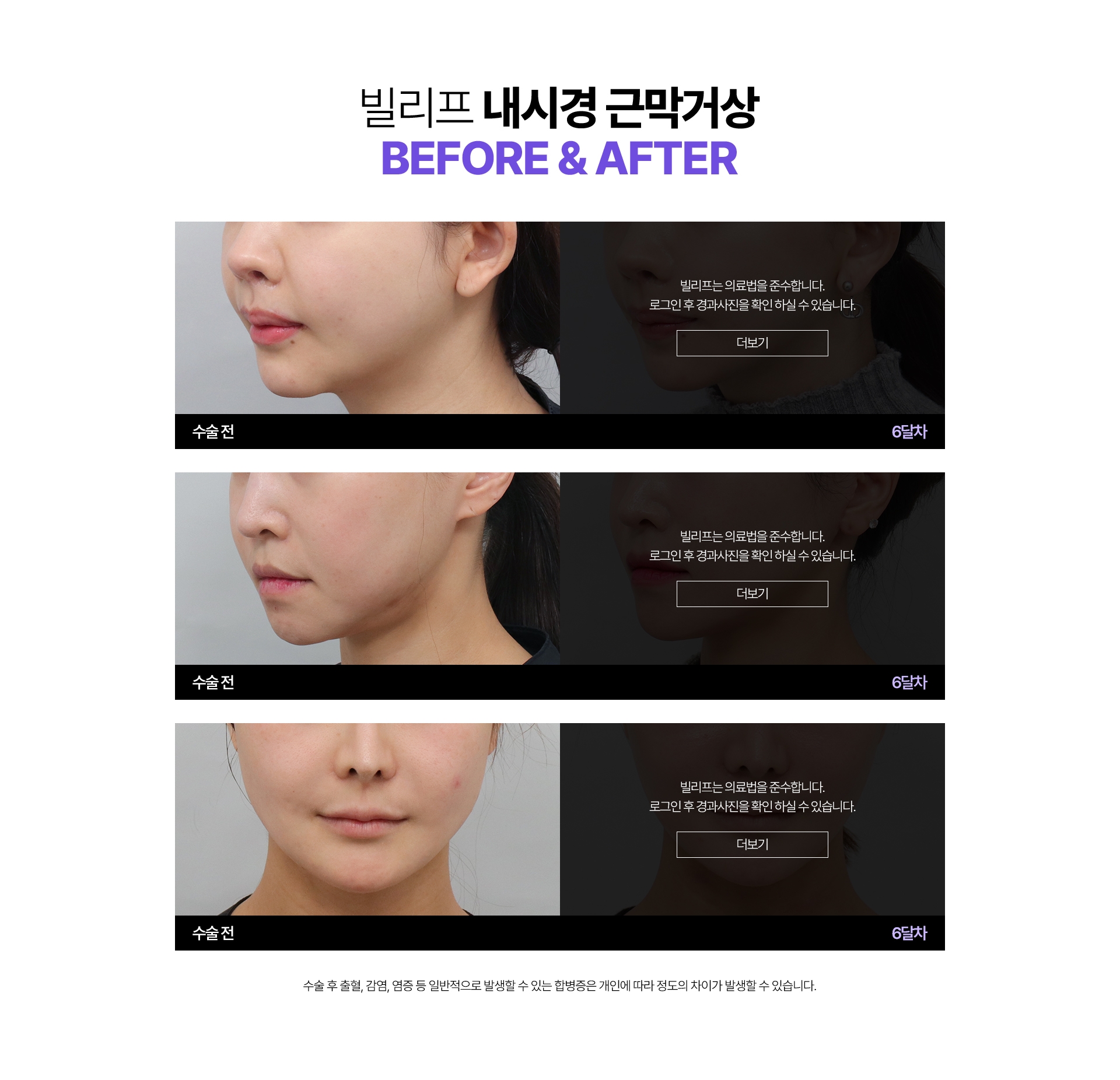 빌리프 내시경 근막거상Before & After 수술전 - 3주차, 수술전 - 6달차, 수술전 - 1달차 수술 후 출혈, 감염, 염증 등 일반적으로 발생할 수 있는 합병증은 개인에 따라 정도의 차이가 발생할 수 있습니다.