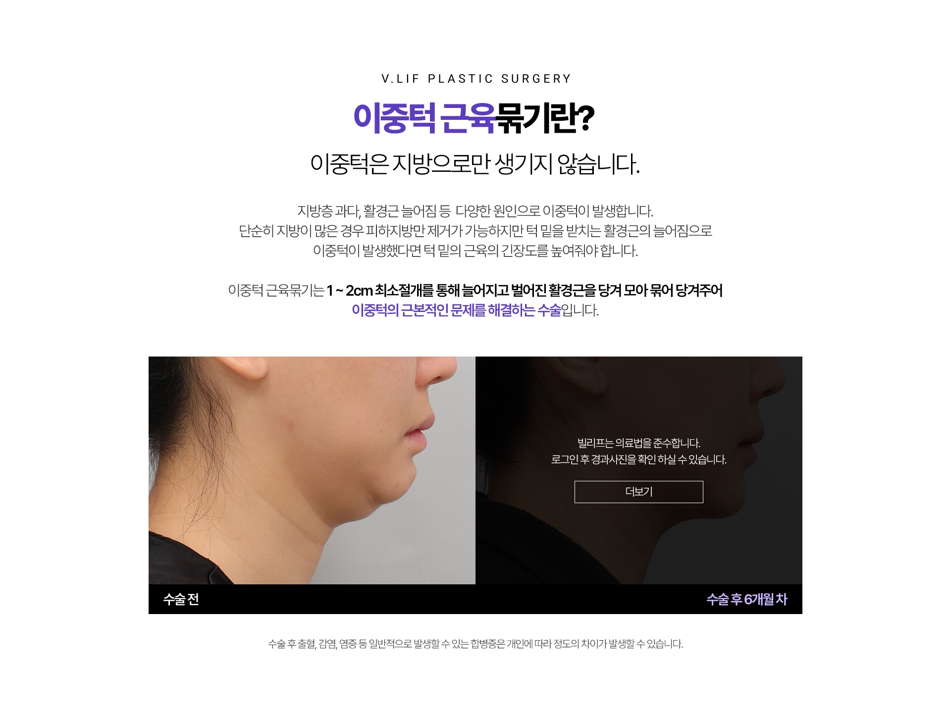 - 이중턱 근육묶기란? 이중턱은 지방으로만 생기지 않습니다. 지방층 과다, 활경근 늘어짐 등  다양한 원인으로 이중턱이 발생합니다. 단순히 지방이 많은 경우 피하지방만 제거가 가능하지만 턱 밑을 받치는 활경근의 늘어짐으로 이중턱이 발생했다면 턱 밑의 근육의 긴장도를 높여줘야 합니다. 이중턱 근육묶기는 1-2cm 최소절개를 통해늘어지고 벌어진 활경근을 당겨 모아 묶어 당겨주어 이중턱의 근본적인 문제를 해결하는 수술입니다. *수술 후 출혈, 감염, 염증 등 일반적으로 발생할 수 있는 합병증은 개인에 따라 정도의 차이가 발생할 수 있습니다.