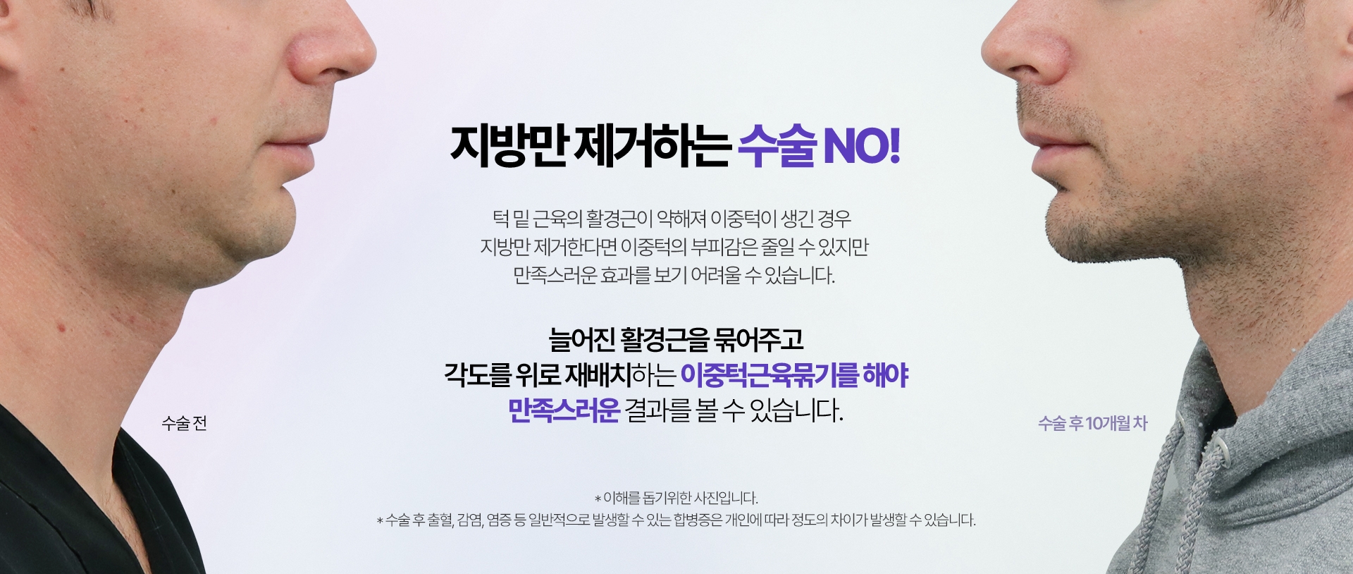 지방만 제거하는 수술 NO! 턱 밑 근육의 활경근이 약해져 이중턱이 생긴 경우 지방만 제거한다면 이중턱의 부피감은 줄일 수 있지만 만족스러운 효과를 보기 어려울 수 있습니다.늘어진 활경근을 묶어주고 각도를 위로 재배치하는 이중턱근육묶기를 해야 만족스러운 결과를 볼 수 있습니다.