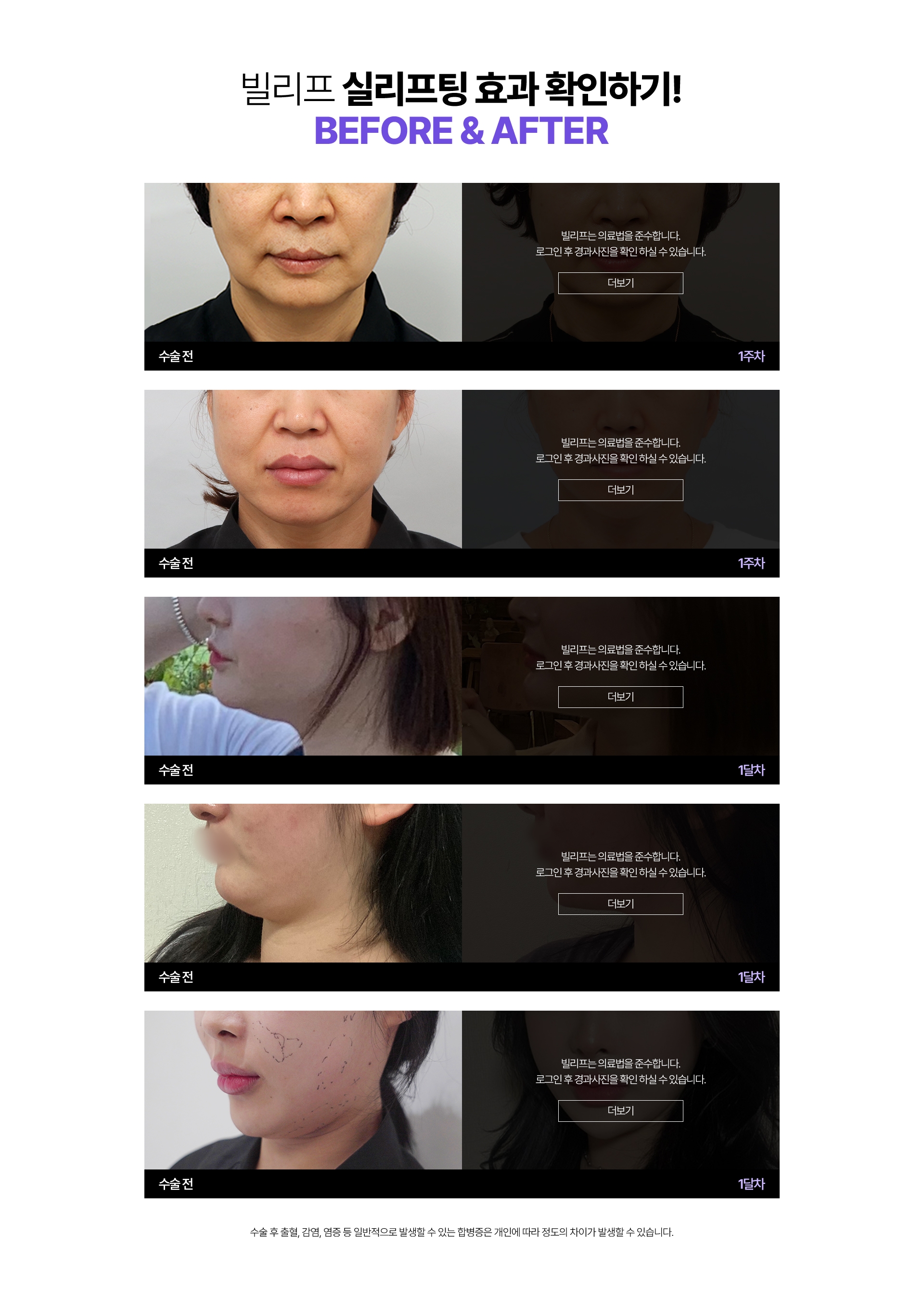 빌리프 실리프팅 효과 확인하기! 시술전 - 1주차